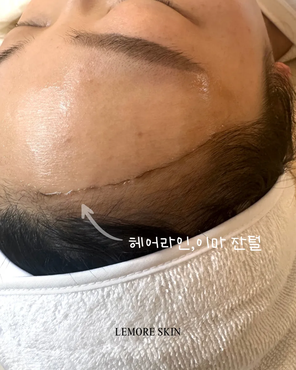 르모어스킨